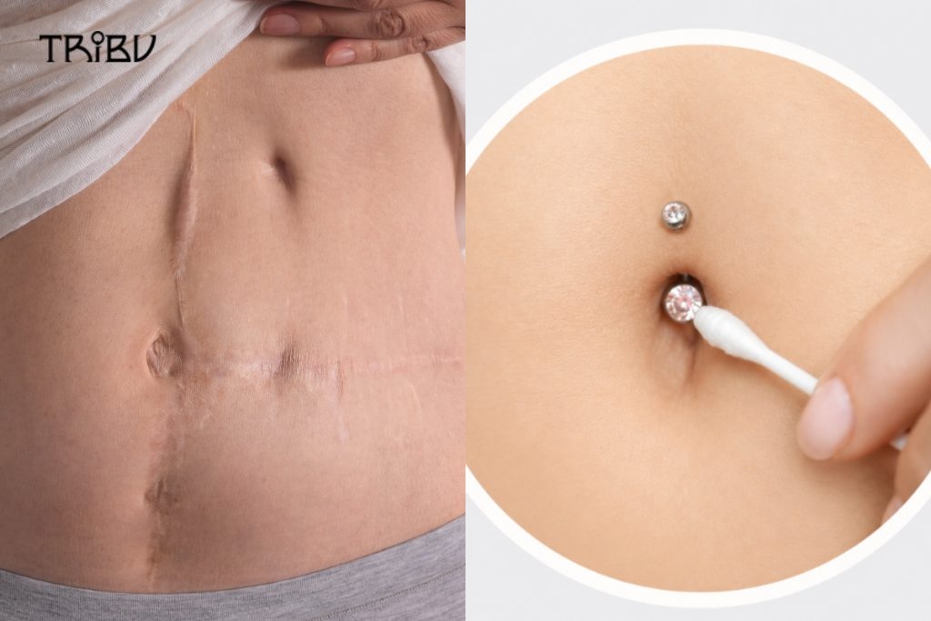 Navel Piercing Through Scar Tissue Placement